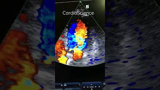 CardioScienceEcocardiograma Doppler Color insuficiencia Aortica [upl. by Abrams]