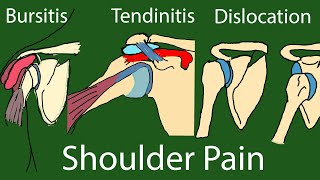 Shoulder Pain  Causes and Treatment Bursitis tendinitis arthritis trauma Tearing [upl. by Dnomed365]