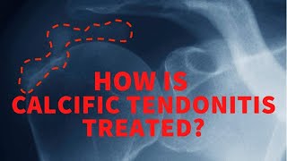 How is calcific tendonitis treated [upl. by Ennovihc604]