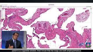 Pathology Insights Atypical Epithelial Cells with Sanjay Mukhopadhyay MD [upl. by Muire884]