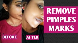 Remove pimples Marks black spots Fast at Home Remedies in 7days💯 homeremedies pimple 7days [upl. by Azirb]