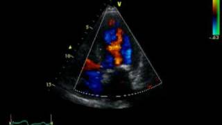 HOCM  AORTIC STENOSIS  LVOT FLOW [upl. by Dena]