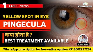 पिंगेकुला क्या होता है कारण लक्षण और उपचार  Pinguecula Causes Symptoms and Treatment [upl. by Hesta]