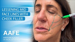 Lessen MidFace Lines with Cheek Filler [upl. by Aiket]