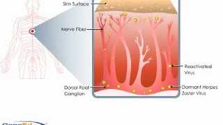 Shingles Pathophysiology [upl. by Lamek795]