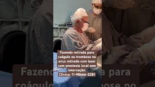 Cirurgia laser p coágulo ou trombose hemorroidaria com anestesia local e sem internação [upl. by Vinnie]