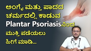 ಅಂಗೈ ಕಾಲಿನ ಪಾದದ ಚರ್ಮ ಚೆನ್ನಾಗಿರೋಕೆ ಹೀಗೆ ಮಾಡಿ  plantar Psoriasis Treatment In Kannada  Skin Care [upl. by Nosauq]