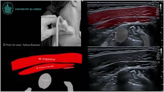 Sonographische Darstellung der seitlichen Nackenmuskeln [upl. by Gabel351]