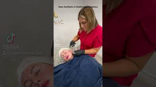 mesotherapy facial drpen dermatology dermalogicaskincare microneedling aesthetic [upl. by Forsyth883]