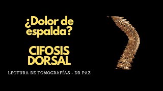 Lectura de Tomografías  ¿Dolor de espalda CIFOSIS DORSAL [upl. by Camella]