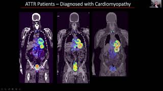 ATTR Amyloid Imaging Update [upl. by Audra123]