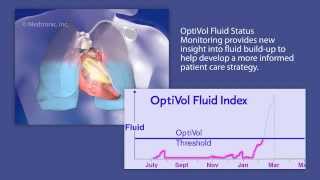 OptiVol Fluid Status Monitoring Making Fluid Visible for Physicians and Allied Health professional [upl. by Cosmo]