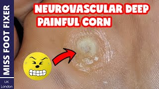 Neurovascular DEEP PAINFUL Corn Removal  Full Thickness Corn  BY MISS FOOT FIXER [upl. by Freddy]