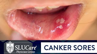 Determining Causes amp Treatment for Canker Sores  SLUCare Otolaryngology [upl. by Galateah]