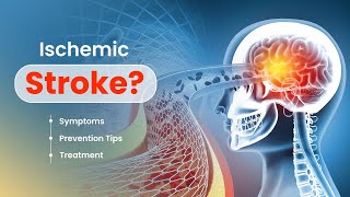 Are you at risk of Ischemic Stroke Symptoms Prevention Tips and Treatment  3D Guide [upl. by Nivlek]