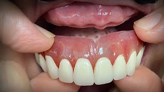 Finalizing a Highly Esthetic Denture with Dentist amp Patient InLab [upl. by Trygve750]