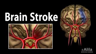 Brain Stroke Types of Causes Pathology Symptoms Treatment and Prevention Animation [upl. by Eicats283]