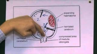 Tentorial herniation [upl. by Llegna]