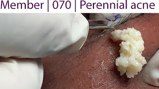 Acne Treatment Huong Da Nang 070  Perennial acne [upl. by Adnuhser]