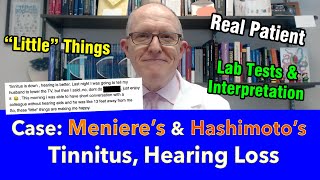 Case Study 52 y Woman with Hashimotos and Menieres Disease  tinnitus hearing loss pressure [upl. by Irrot709]