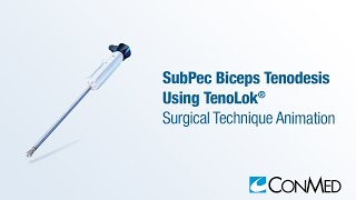 SubPec Biceps Tenodesis Using TenoLok®  CONMED Animation [upl. by Staffan]