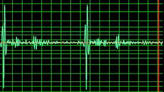 Aortic Regurgitation Ejection Systolic Murmur normal speed [upl. by Ash]