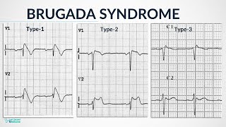 Brugada Syndrome  Pathology Types Diagnosis amp Management [upl. by Burny]