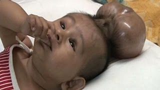 Baby Born With Two Heads  Extraordinary Birth [upl. by Ok]