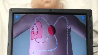 Mixed simulation of a neonate METI BabySIM with Hypoplastic Left Heart Syndrome Patent Pending [upl. by Notwen101]