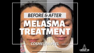 Cosmelan Peel for Melasma in Orange County with Results [upl. by Fabi]