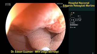 Underwater endoscopic mucosal resection UEMR of a colonic large pedunculated polyp [upl. by Debby]