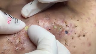 Big Cystic Acne Blackheads Extraction Blackheads amp Milia Whiteheads Removal Pimple Popping  292 [upl. by Ellita]