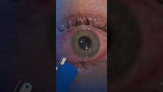 Marburg virus  potential eye issues [upl. by Antonella]