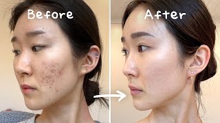 3 Secrets to Clearing Acne Without Medication No Accutane  Tretinoin [upl. by Airotkciv101]