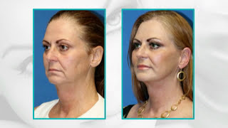 Facial Plastic Surgery Before and After 15 Years Younger Facelift facial fat transfer eyelid [upl. by Karrah]