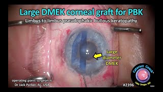 CataractCoach™ 2396 large DMEK corneal graft for PBK [upl. by Schargel307]