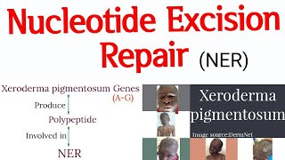 DNA Repair mechanism  Nucleotide Excision Repair II Xeroderma pigmentosum cause and features [upl. by Akiemaj]