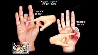 Trigger Finger amp Trigger Thumb  Everything You Need To Know  Dr Nabil Ebraheim [upl. by Groscr213]