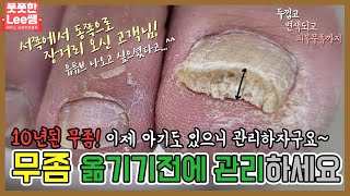 10년된 무좀 가족에게 옮기기전에 관리받으세요 tinea unguium  athletes foot  Fresh Foot 성수점  남양주호평점 [upl. by Vitalis]