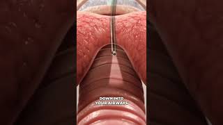 medicalanimation bronchoscopy [upl. by Drol785]