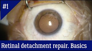 The general principles of vitrectomy for retinal detachment repair [upl. by Areyk]