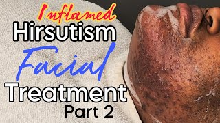 Inflamed Hirsutism Session Part 2 Facial Treatment Lets Soothe Her Skin [upl. by Atnahs559]