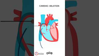 Cardiac Ablation cardiology [upl. by Aissac562]