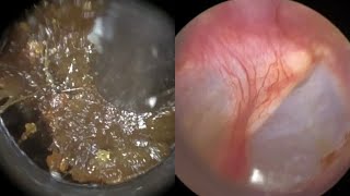 173  Ear Wax Removal In Bruised Ear Stained with Blood due to Cotton Swab Misuse with the WAXscope [upl. by Louth128]