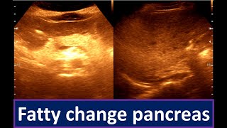 Moderately diffuse fatty infiltration of the Liver  Fatty change pancreas [upl. by Erdua393]