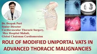 ROLE OF MODIFIED UNIPORTAL VATS IN ADVANCED THORACIC MALIGNANCIES  DR Deepak Puri  Max Hospital [upl. by Gonta396]