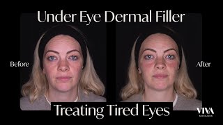 Under Eye Filler Before and After 😴 2021 [upl. by Annibo]