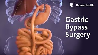 Gastric Bypass Surgery  Duke Health [upl. by Kieger272]