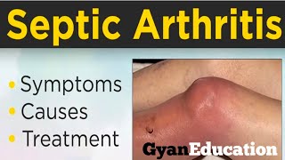 Septic Arthritis kya haifull treatment kya haiGyanEducation11 [upl. by Awhsoj326]