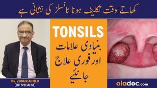 Tonsils Ka Ilaj In Urdu  Tonsils Symptoms Treatment  Galay Ke Gadood Barhna  Tonsils Ki Alamat [upl. by Lamberto]